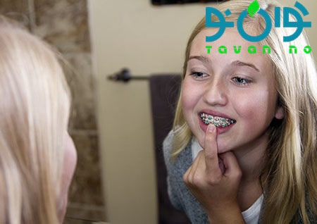 درمان پوسیدگی دندان در زمان ارتودنسی-01